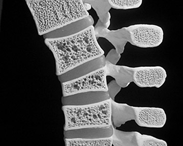 Bone density measurement