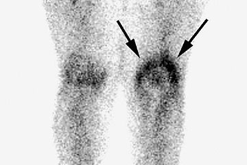 Full Body Scintigraphy