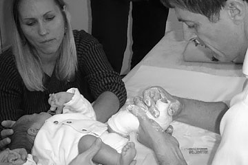 Plaster cast for clubfoot