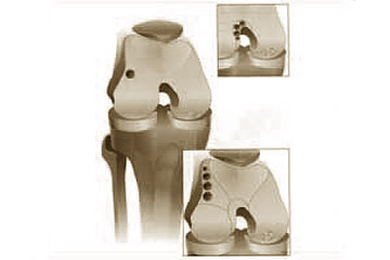 Knorpelzelltransplantation