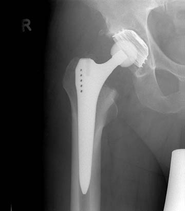 Artificial hip replacement x-ray picture