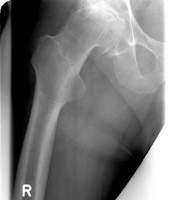 Artificial hip replacement Berlin-Frohnau