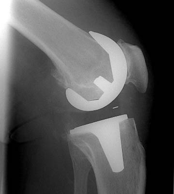 Artificial knee replacement x-ray picture