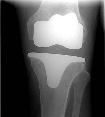 Artificial knee replacement Berlin Frohnau
