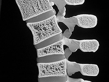 Knochendichtemessung Berlin Frohnau - Osteodensitometrie