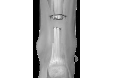 ACP bei Arthrose