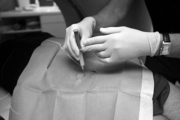Minimalinvasive-Behandlung-der-Bandscheibe