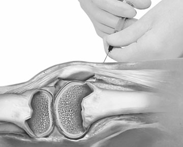 Protektive Gelenktherapie