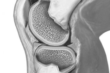 Protektive Knorpelschutztherapie Berlin-Frohnau