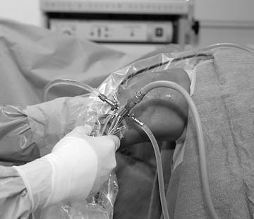 Arthroskopie am Knie in Berlin